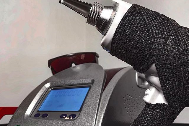 Laser Tattoo Removal in Birmingham