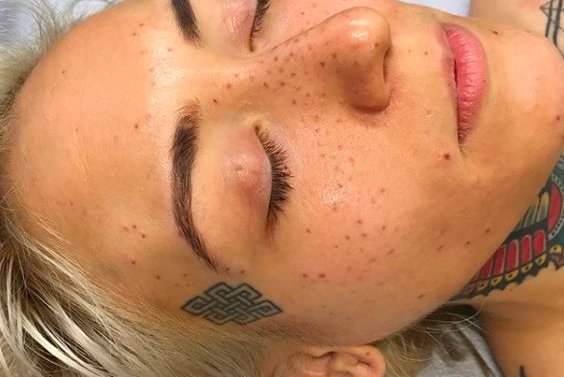 Freckle tattoos