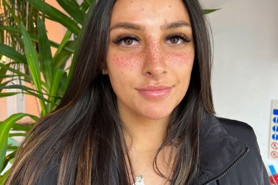 Freckle tattoos