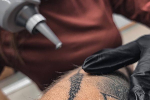 Laser tattoo removal in Walsall