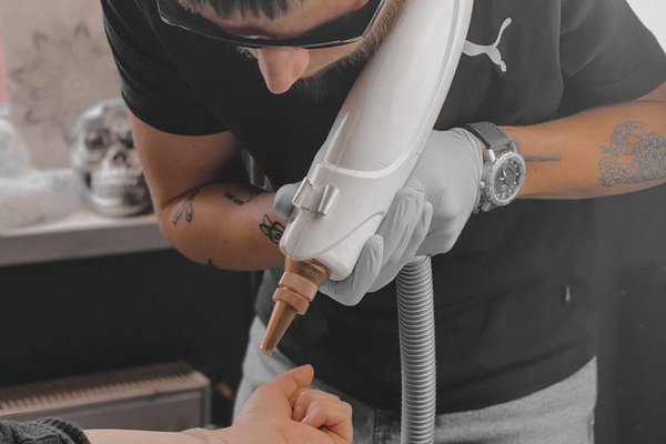 tattoo removal