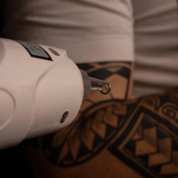 Laser tattoo removal in Walsall